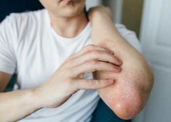 Signs of Psoriasis