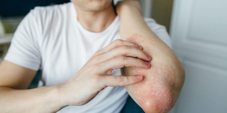 Signs of Psoriasis