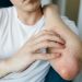 Signs of Psoriasis